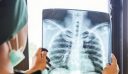 Τζανάκης: Μία μικρή πόλη χάνεται κάθε χρόνο στην Ευρώπη από καρκίνο του πνεύμονα