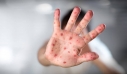 Τρία κρούσματα ιλαράς σε ενήλικες στην Κρήτη – Τα 6 μέτρα του υπουργείου Υγείας