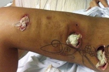 ΠΡΟΣΟΧΗ ΣΚΛΗΡΗ Εικόνα στο νοσοκομείο – Από πλαστική μοντέλο κινδύνευσε να χάσει το πόδι της!! [pic]