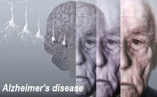 Προειδοποιητικά σημάδια της νόσου   – Αλτσχάιμερ