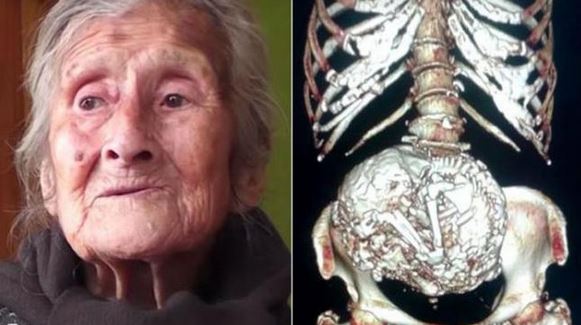 Απίστευτο!! Γυναίκα 91 ετών κουβαλούσε επί 60 χρόνια νεκρό έμβρυο!!