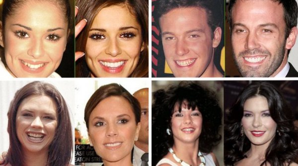 Φωτογραφίες πριν και μετά: Οι celebrities που έφτιαξαν τα δόντια τους (φωτό)