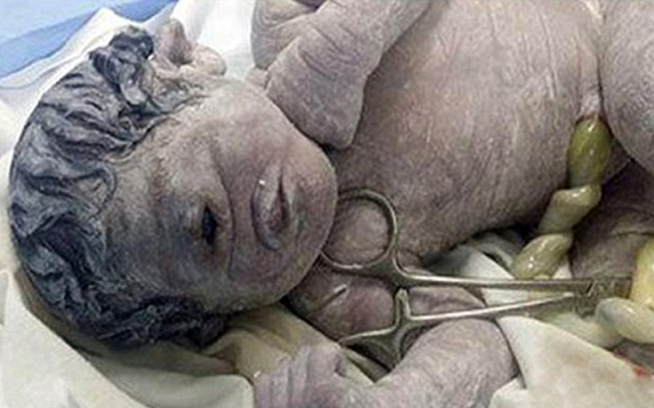 Μωρό-κύκλωπας γεννήθηκε στην Αίγυπτο