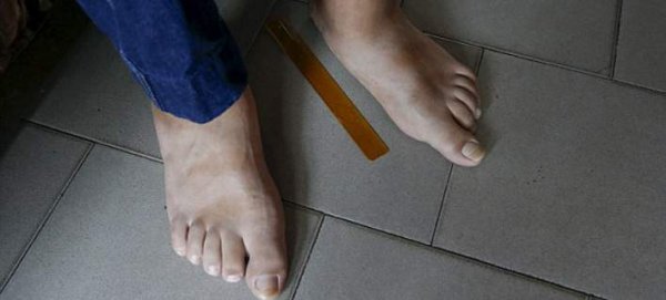 Ο άνθρωπος με τα μεγαλύτερα πόδια στον κόσμο- Φοράει νούμερο 80! [εικόνες]