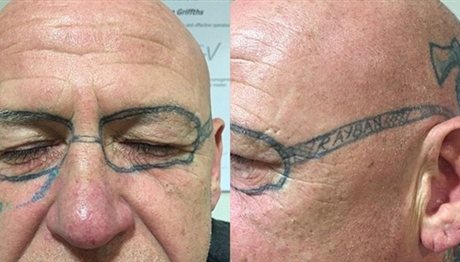 Έγινε «τύφλα» στο μεθύσι και ξύπνησε με τατουάζ… γυαλιά στο πρόσωπο