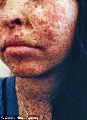 To κορίτσι με το σπάνιο σύνδρομο του βρυκόλακα: Η φρικτή πάθηση που της έχει καταστρέψει τη ζωή