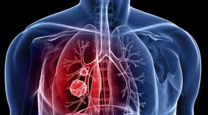 Διεπιστημονική συνάντηση: «Ο καρκίνος του πνεύμονα με μια άλλη… ματιά»