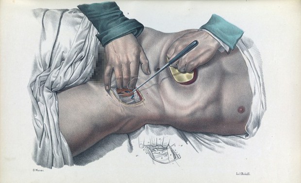 Πώς γίνονταν οι χειρουργικές επεμβάσεις το 1840. Συγκλονιστικές εικόνες από χειρουργεία χωρίς αναισθητικό
