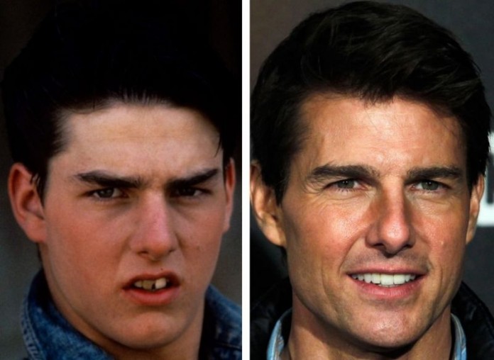 Διάσημοι του Hollywood Πριν και Μετά: 22 Άσχημα Χαμόγελα που Έγιναν Τέλεια