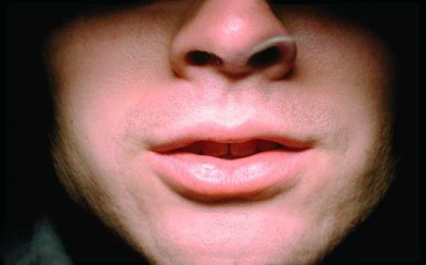 Καρκίνος του στόματος: Η ουσία που εξοντώνει τα καρκινικά κύτταρα