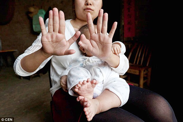 Μωρό στην Κίνα γεννήθηκε με 31 δάχτυλα σε χέρια και πόδια(ΦΩΤΟ)