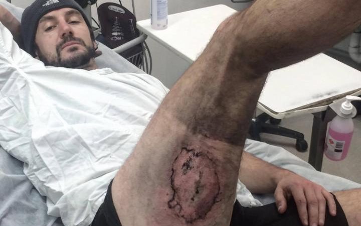 Ποδηλάτης υπέστη σοβαρό έγκαυμα όταν πήρε φωτιά το iPhone στην τσέπη του