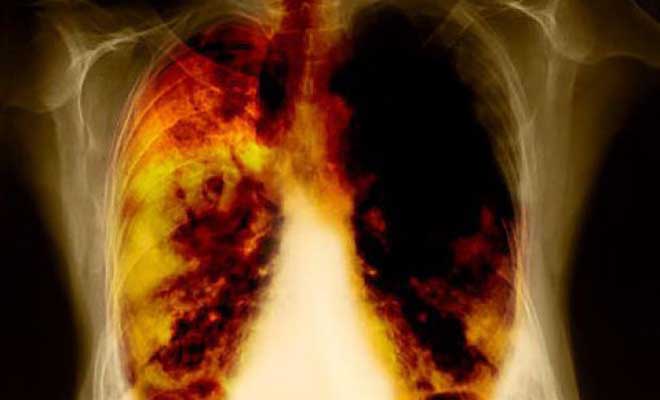 Γιατί μερικοί καπνιστές έχουν καθαρούς πνεύμονες