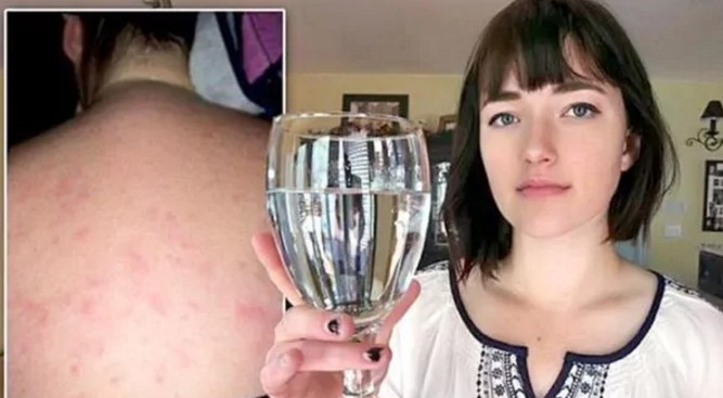 Δεν ξανάγινε! Αυτή η κοπέλα έχει αλλεργία στο νερό! Δείτε πώς γίνεται το δέρμα της! [photo]