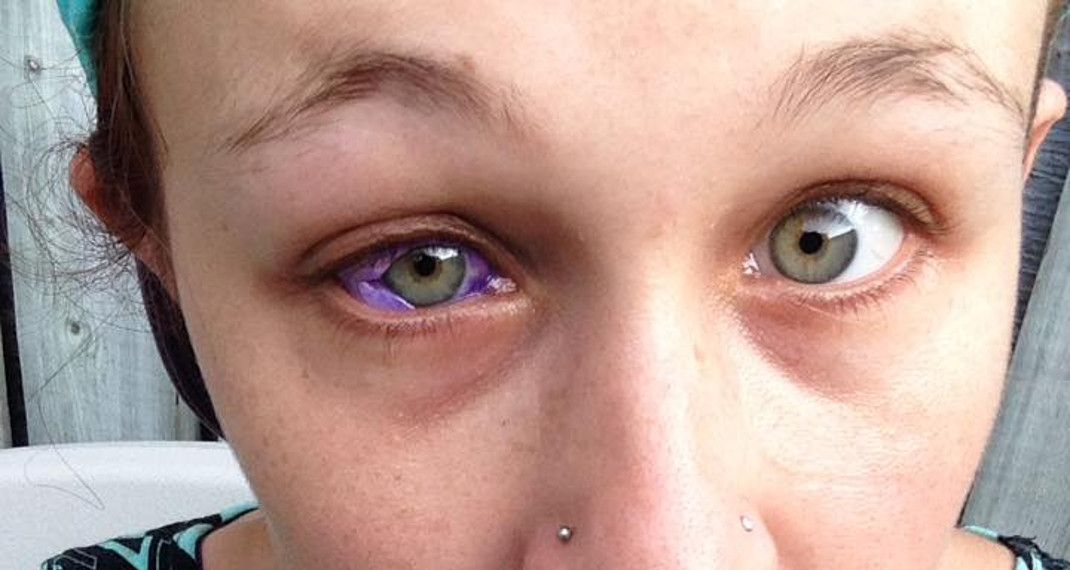 24χρονο μοντέλο σε κατάσταση σοκ: Κινδυνεύει με τύφλωση μετά από τατουάζ στο μάτι (εικόνες & βίντεο)