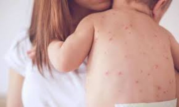 Εθνική Επιτροπή Εμβολιασμών : Οδηγίες για την ιλαρά