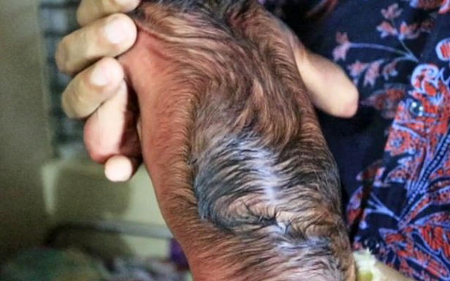 Γεννήθηκε νεογέννητο που δείχνει 80 χρονών! Ρυτίδες, ζαρωμένο σώμα και παχύ τρίχωμα