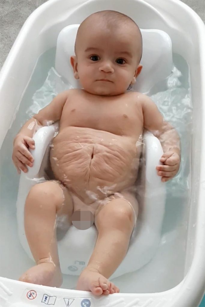 Αγοράκι γεννήθηκε χωρίς κοιλιακούς μύες