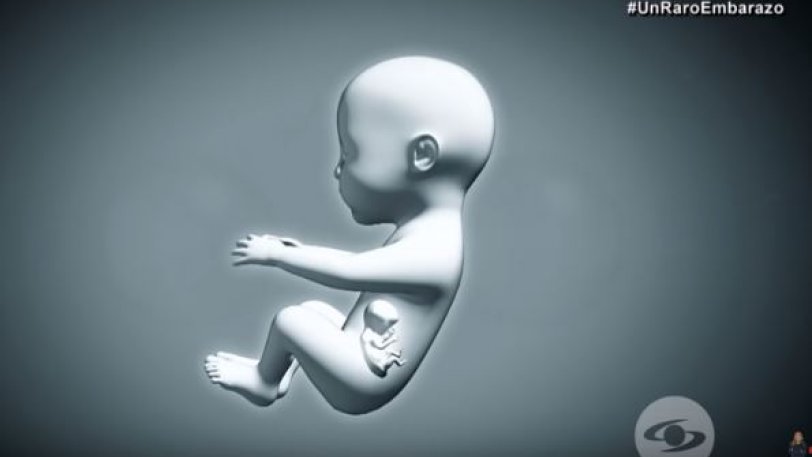 Μια φορά στις 500 χιλιάδες: Νεογέννητο είχε μέσα στην κοιλιά του το δίδυμο αδελφάκι του (εικόνες & βίντεο)