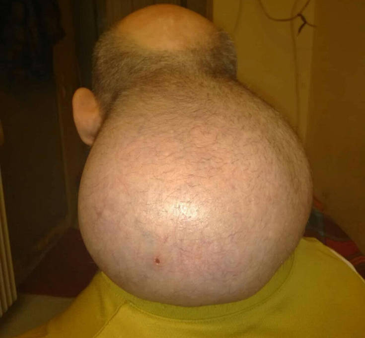 Κρατούμενος στις φυλακές Νιγρίτας Σερρών έχει όγκο που μοιάζει με… δεύτερο κεφάλι