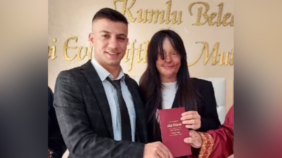 Σάλος στην Τουρκία: 20χρονη παντρεύτηκε τον άνδρα που την παραμόρφωσε με οξύ