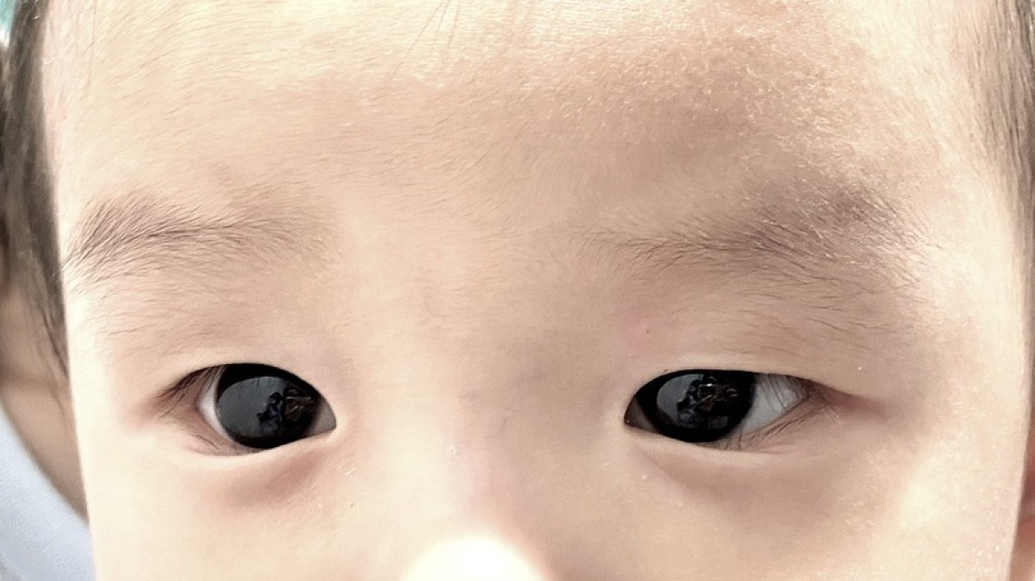 Ταϊλάνδη: Φάρμακο κατά του κορωνοϊού «άλλαξε προσωρινά» το χρώμα των ματιών ενός μωρού